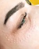 .Биоревитализация кожи вокруг глаз.